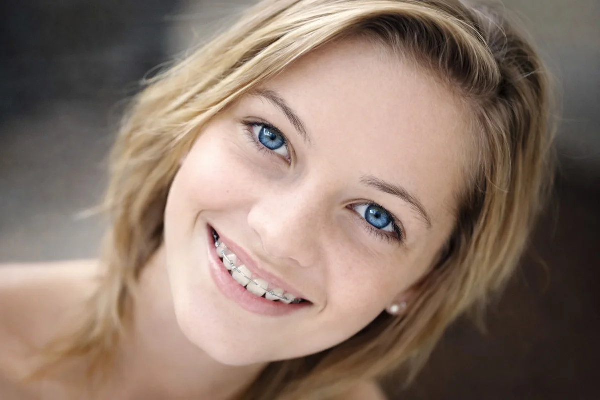 clear braces