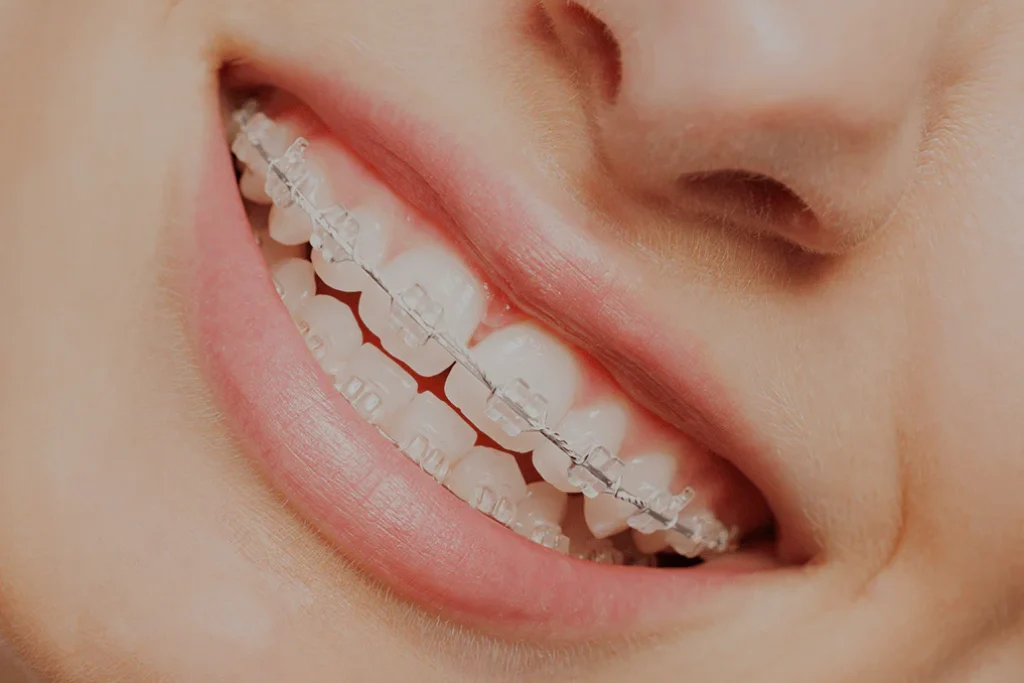 what are ceramic braces